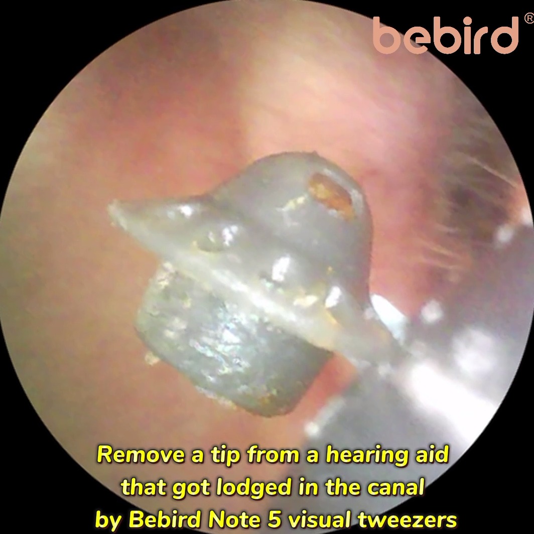Real Case: Remove a tip from a hearing aid that got lodged in the canal by Bebird Note 5 smart visual tweezers